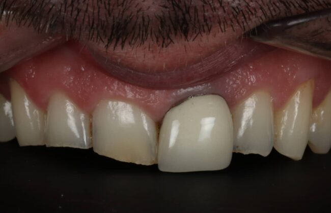 Before (Teeth)