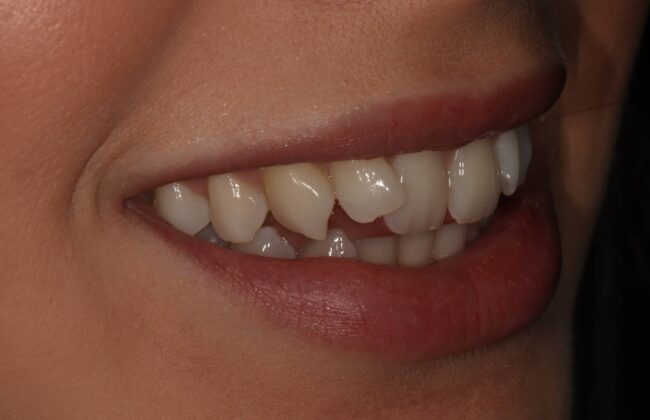 Before (Teeth)