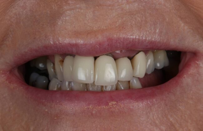 Before (Teeth)