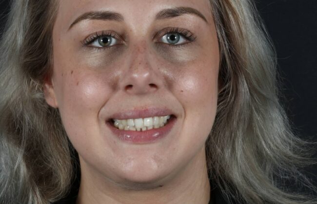 Before (Teeth)