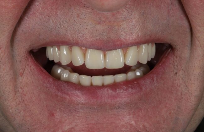 After (Teeth)