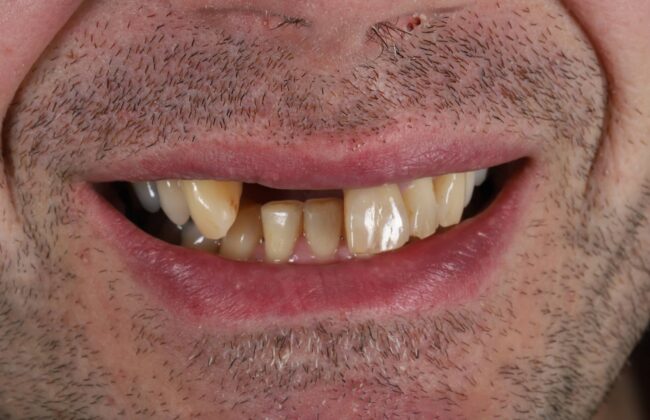 Before (Teeth)