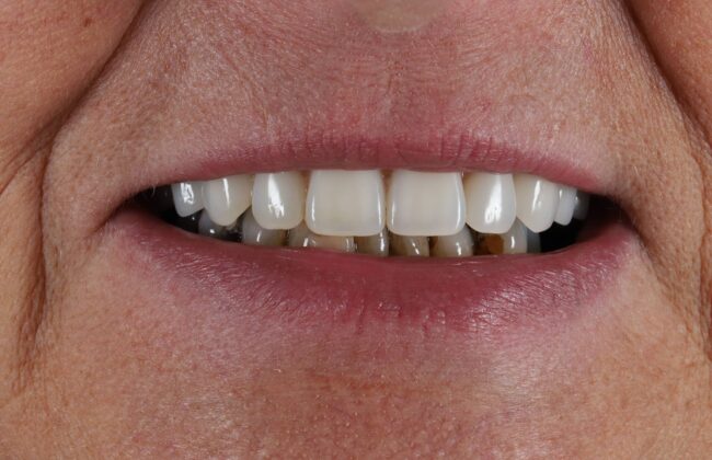 After (Teeth)