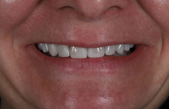 After (Teeth)