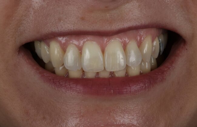 After (Teeth)