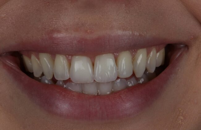 After (Teeth)