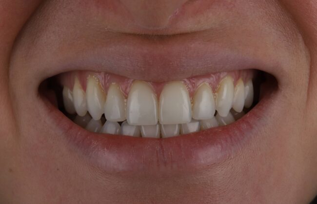 After (Teeth)