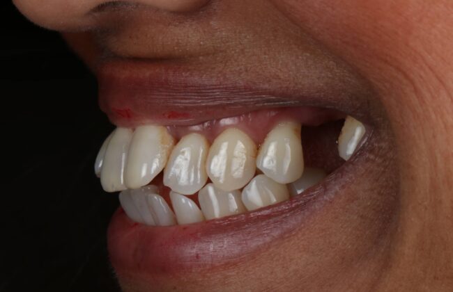 Before (Teeth)