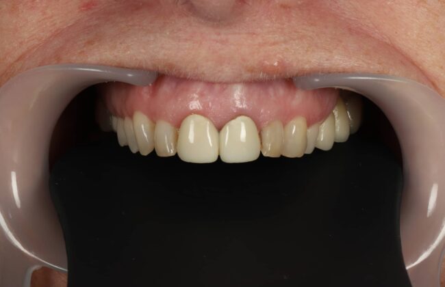 Before (Teeth)