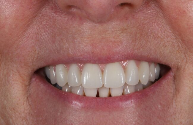 After (Teeth)