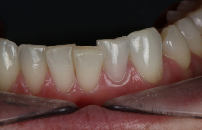 After (Teeth)