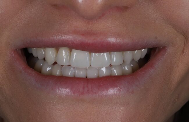 After (Teeth)