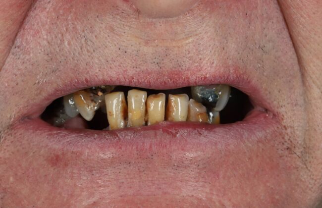 Before (Teeth)