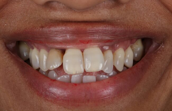 Before (Teeth)