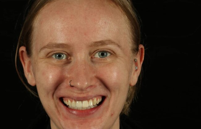 After (Teeth)
