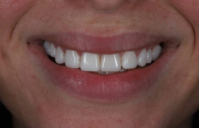 After (Teeth)
