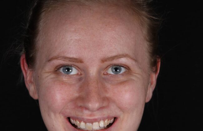 Before (Teeth)