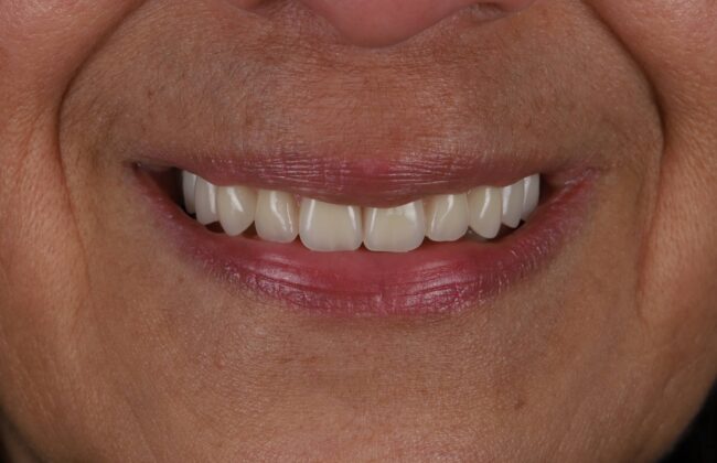 After (Teeth)