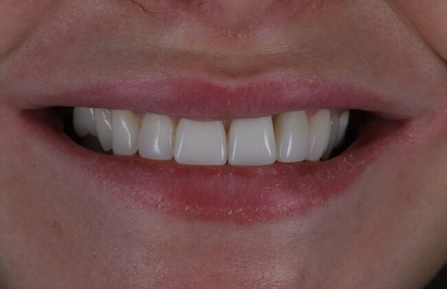 After (Teeth)