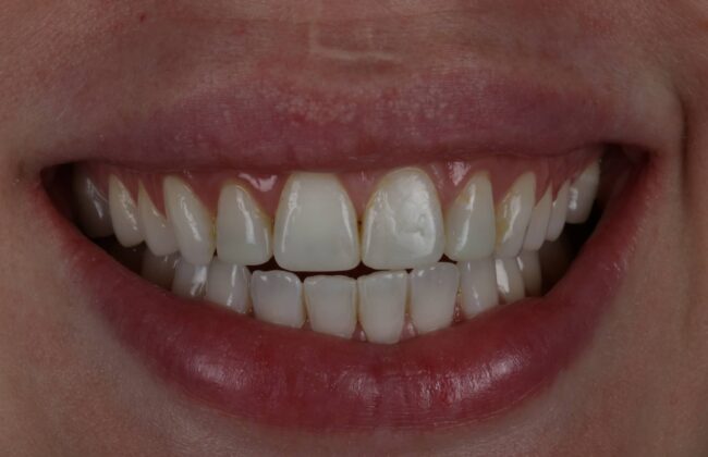After (Teeth)