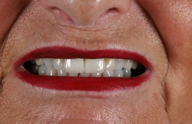 After (Teeth)