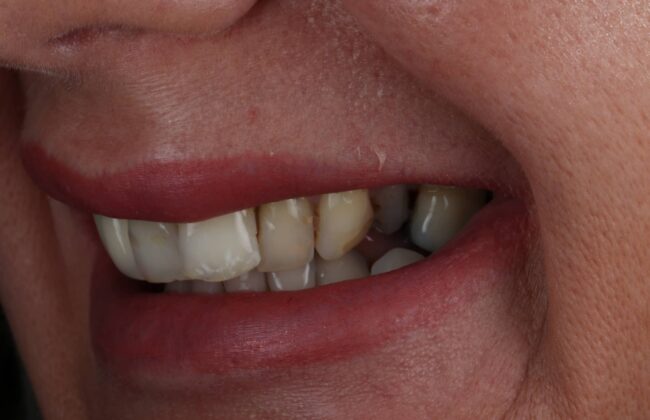 Before (Teeth)