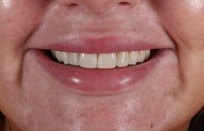 After (Teeth)