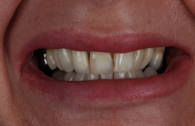 Before (Teeth)