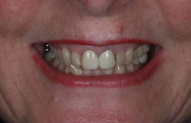Before (Teeth)