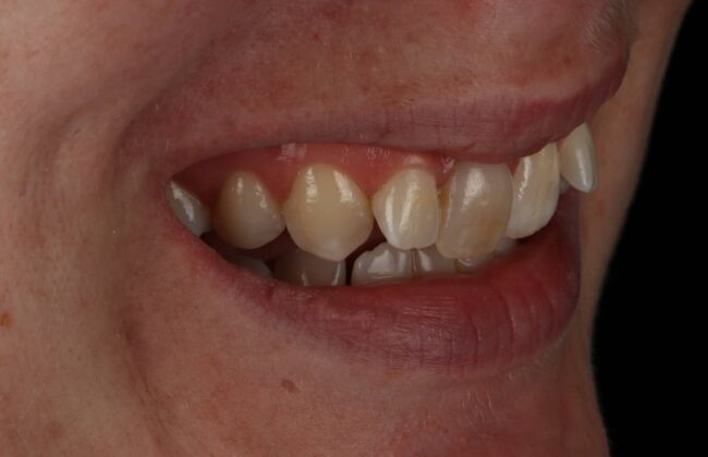 Before (Teeth)