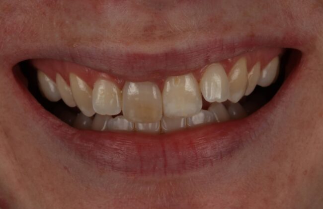 Before (Teeth)