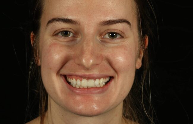 After (Teeth)
