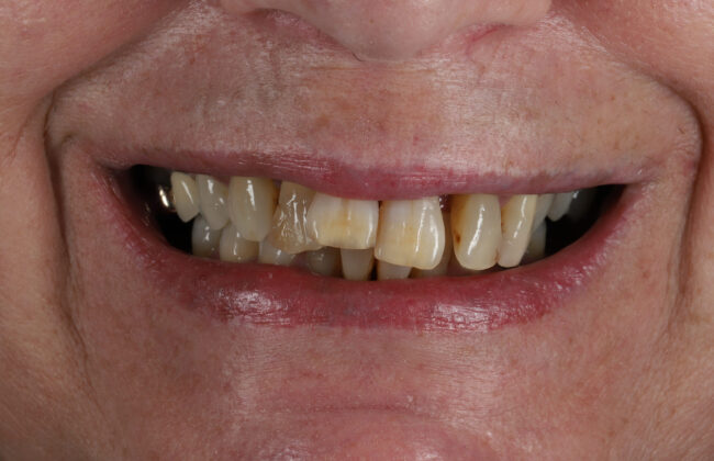 Before (Teeth)