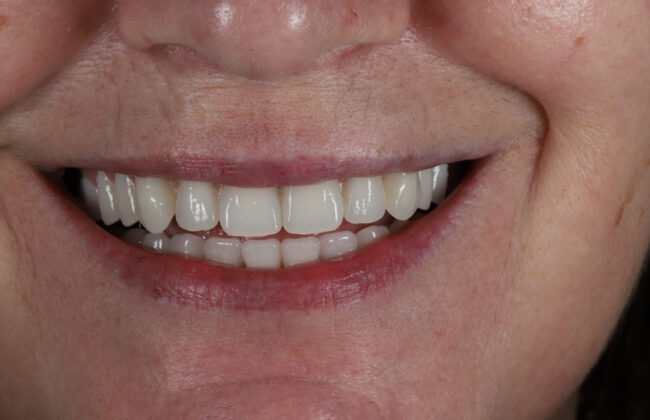 After (Teeth)