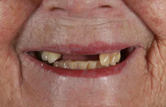 Before (Teeth)
