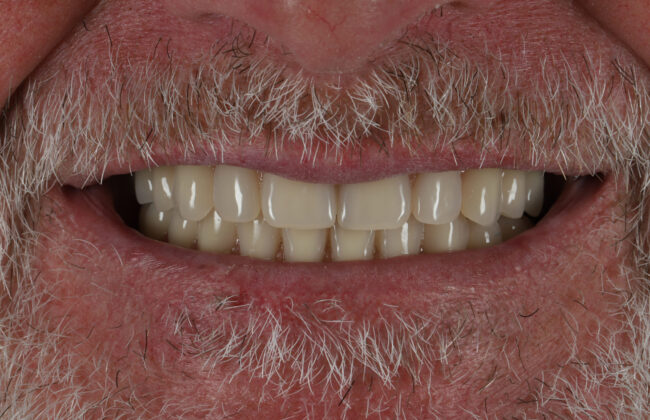 After (Teeth)