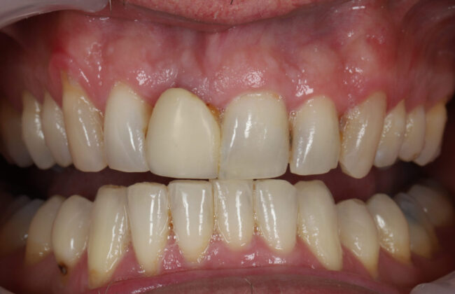 Before (Teeth)