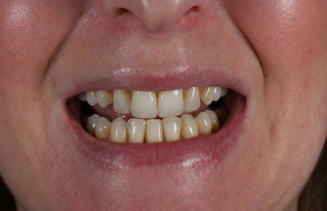 After (Teeth)