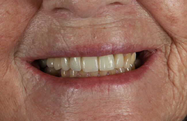 After (Teeth)