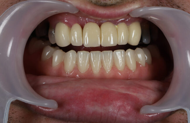 After (Teeth)