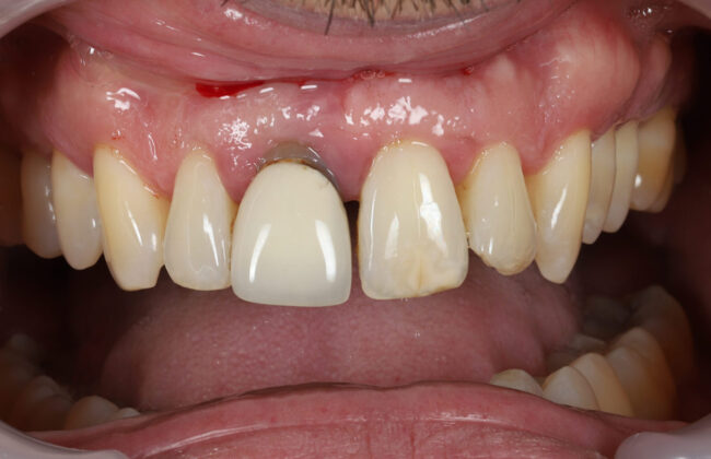 Before (Teeth)