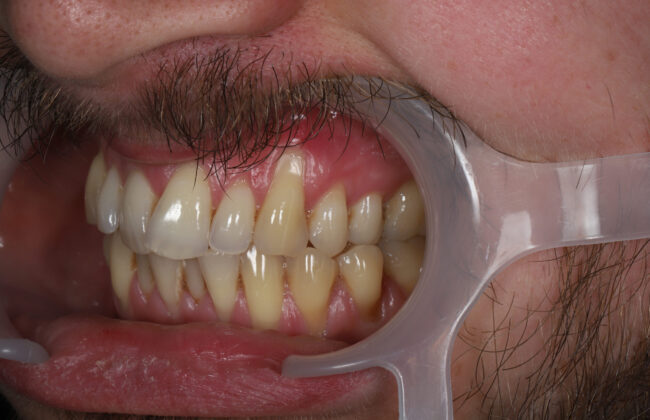 Before (Teeth)