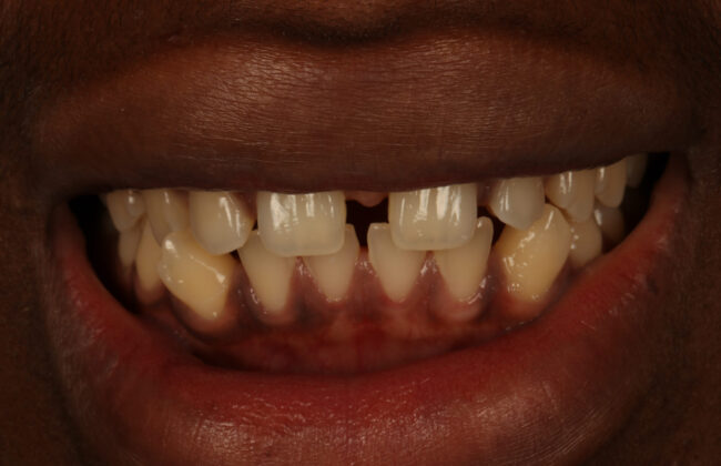 Before (Teeth)