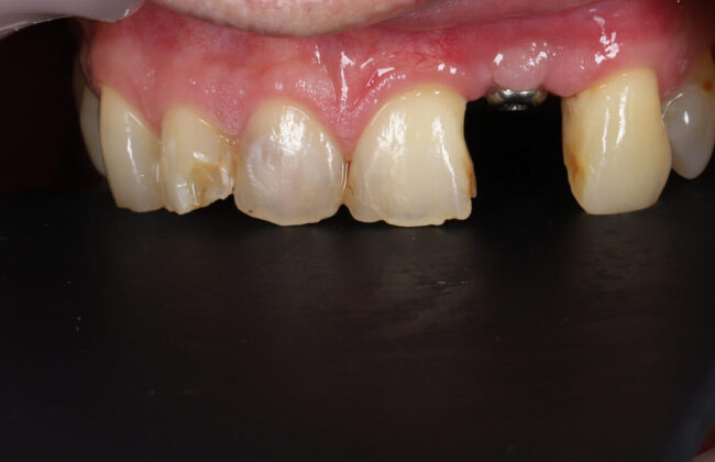 Before (Teeth)