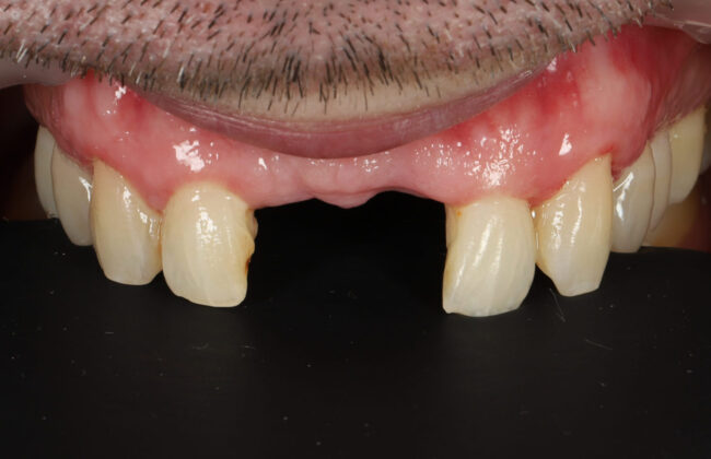 Before (Teeth)