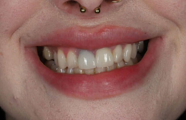 Before (Teeth)