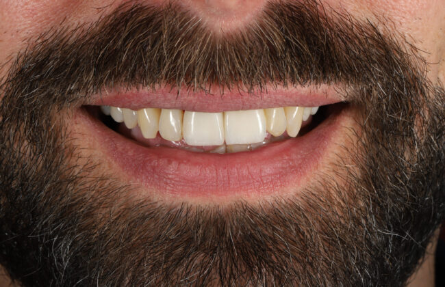 After (Teeth)