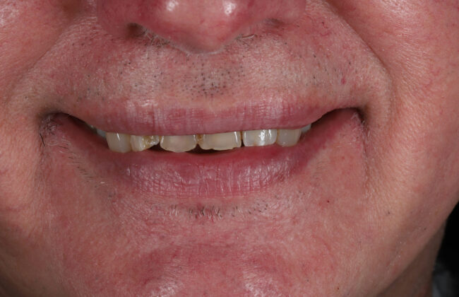 After (Teeth)