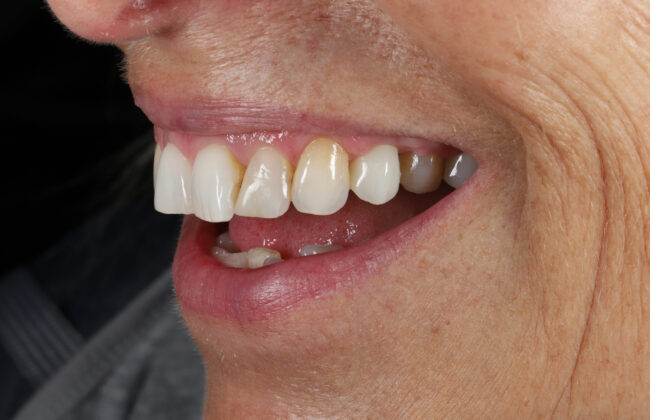 After (Teeth)