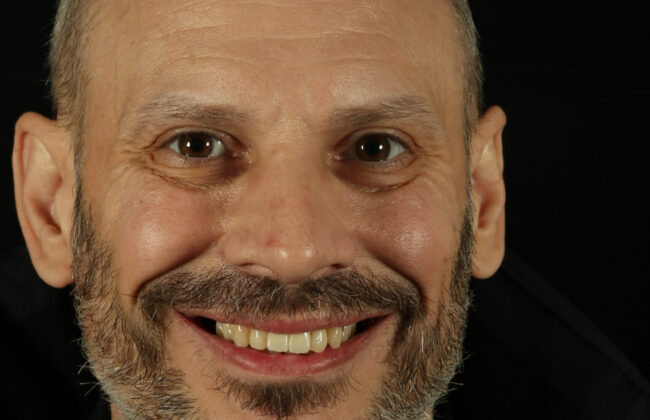 After (Teeth)